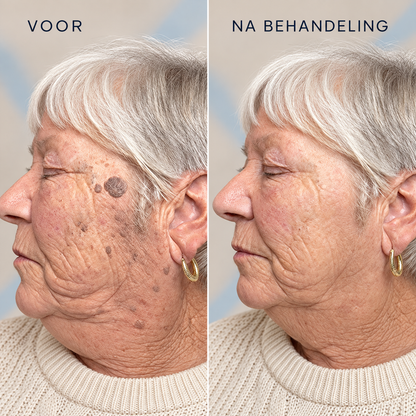 Novren ClearBump™ SkinRenew Verzorgingsroller 1+1 GRATIS