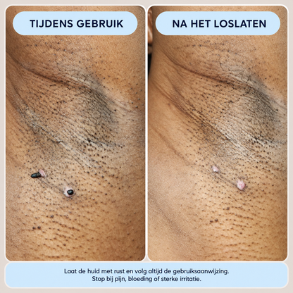 Novren ClearBump™ SkinRenew Verzorgingsroller 1+1 GRATIS